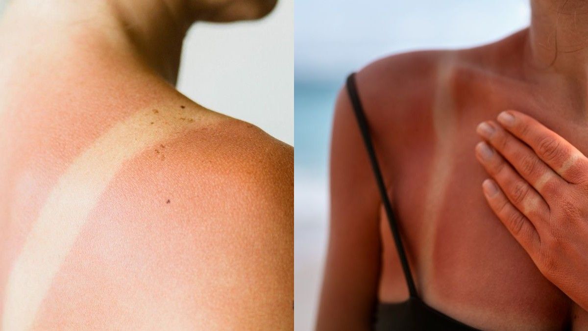 Поради, які допоможуть при опіках Поради, які допоможуть при опіках